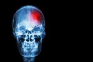 Danville Traumatic Brain Injury Lawyer