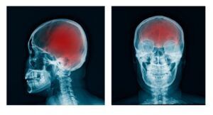 Indiana Traumatic Brain Injury Lawyer